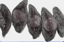 Đau bụng âm ỉ, đi khám ngỡ ngàng vì khối dị dạng hiếm gặp ở nách