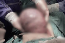 Khó thở nhưng chần chừ đi khám, bệnh nhân bị khối u đặc đè xẹp phổi