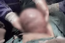 Khó thở nhưng chần chừ đi khám, bệnh nhân bị khối u đặc đè xẹp phổi