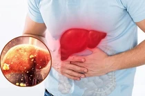 Cảnh báo 5 thói quen tàn phá gan vào mùa lạnh