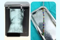 Bé trai 3 tuổi thủng ruột 8 chỗ... vì nuốt phải 31 viên nam châm