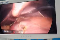 Đau bụng dữ dội, buồn nôn, đi khám phát hiện thủng dạ dày