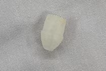 Gắp dị vật đầu bút trong đường thở bé trai 6 tuổi