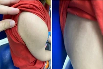 Bé trai suy tuyến thượng thận do tự ý dùng "thuốc đông y tăng cân"