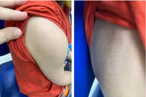 Bé trai suy tuyến thượng thận do tự ý dùng "thuốc đông y tăng cân"