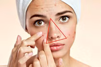 Tại sao không nên nặn mụn ở vùng “tam giác tử thần”?