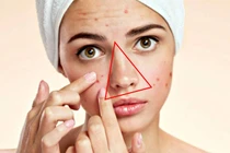 Tại sao không nên nặn mụn ở vùng “tam giác tử thần”?