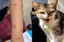 Cả gia đình nhiễm nấm da lây từ mèo, bác sĩ cảnh báo