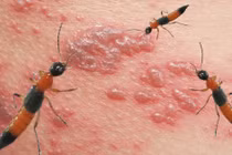 Biểu hiện viêm da tiếp xúc do kiến ba khoang gây ra