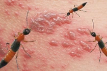 Biểu hiện viêm da tiếp xúc do kiến ba khoang gây ra