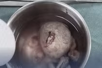 Lấy viên sỏi bàng quang "to như quả trứng gà" cho bệnh nhân 49 tuổi