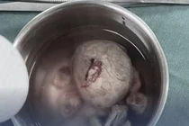 Lấy viên sỏi bàng quang "to như quả trứng gà" cho bệnh nhân 49 tuổi