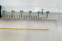 Thủng dạ dày vì vô tình nuốt phải tăm khi đang cổ vũ bóng đá