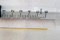 Thủng dạ dày vì vô tình nuốt phải tăm khi đang cổ vũ bóng đá