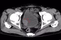 Tiểu rắt liên tục, đi khám bất ngờ phát hiện u bàng quang