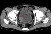 Tiểu rắt liên tục, đi khám bất ngờ phát hiện u bàng quang