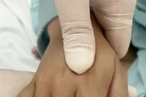 Bé trai 7 tuổi bị bỏng tay khi rút điện thoại đang sạc