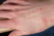 "Điểm mặt" 5 bệnh về da dễ gặp vào mùa mưa