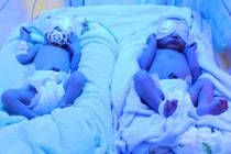Cứu sống cặp song sinh non tháng suy hô hấp, nhiễm trùng sơ sinh