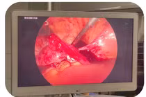 Phẫu thuật cấp cứu thành công bệnh nhân chửa ngoài tử cung vỡ 