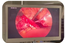 Phẫu thuật cấp cứu thành công bệnh nhân chửa ngoài tử cung vỡ 