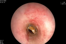 Biến chứng nguy hiểm của dị vật đường thở