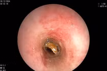 Biến chứng nguy hiểm của dị vật đường thở