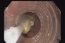 Nhập viện vì... nghẹn gân bò