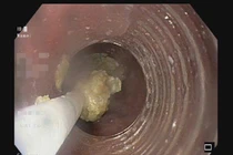 Nhập viện vì... nghẹn gân bò