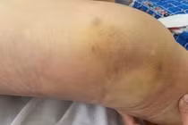 Cảnh báo những tai biến thường gặp do tự điều trị bệnh xương khớp