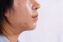 Bỏ túi 5 công thức mặt nạ giúp kiềm dầu, se khít lỗ chân lông