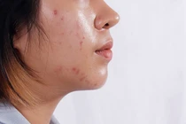 Bỏ túi 5 công thức mặt nạ giúp kiềm dầu, se khít lỗ chân lông