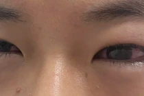 Bỏng giác mạc do gội đầu bằng nước hạt na: Lời cảnh tỉnh cho cha mẹ