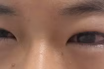 Bỏng giác mạc do gội đầu bằng nước hạt na: Lời cảnh tỉnh cho cha mẹ