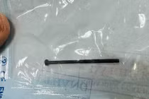 Gắp dị vật đinh vít dài 4cm trong dạ dày bé trai 3 tuổi