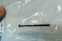 Gắp dị vật đinh vít dài 4cm trong dạ dày bé trai 3 tuổi