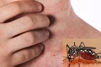 Phân biệt sốt xuất huyết và sốt thông thường, dấu hiệu nào cần lưu ý?