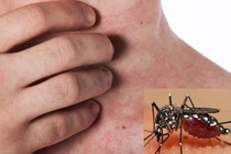 Phân biệt sốt xuất huyết và sốt thông thường, dấu hiệu nào cần lưu ý?