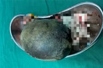 Lấy viên sỏi "khủng" nặng đến 700g, trong bàng quang người đàn ông 45 tuổi