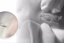 Đi câu cá, bé trai 5 tuổi bị lưỡi câu găm sâu vào mắt