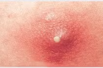 Bé trai 11 tuổi viêm phổi hoại tử nặng vì nhiễm khuẩn từ nốt nhọt