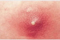 Bé trai 11 tuổi viêm phổi hoại tử nặng vì nhiễm khuẩn từ nốt nhọt