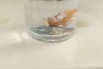 Đau ngực, khó thở, đi khám bất ngờ phát hiện răng giả mắc kẹt trong phổi