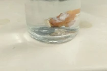 Đau ngực, khó thở, đi khám bất ngờ phát hiện răng giả mắc kẹt trong phổi