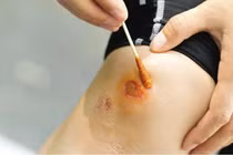 Bị vết thương hở nên kiêng thực phẩm nào?