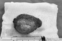 Lấy khối u tuyến giáp khổng lồ "đeo bám" trên cổ nữ sinh suốt 4 năm