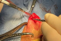 Bóc tách thành công khối u lưỡi cho bệnh nhân 36 tuổi