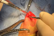 Bóc tách thành công khối u lưỡi cho bệnh nhân 36 tuổi