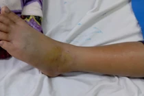 Cảnh báo gia tăng trẻ nhập viện do rắn cắn trong mùa mưa