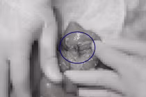 Bệnh nhi thủng ruột, sốc nhiễm khuẩn do.... nuốt phải hạt táo đỏ